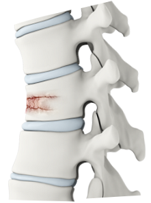 127 Vertebral Compression Fracture Stock Photos - Free & Royalty-Free Stock  Photos from Dreamstime