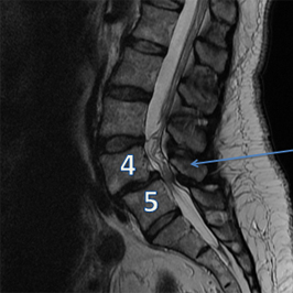 Антеспондилолистез позвоночника поясничного отдела. Спондилолистез пояснично-крестцового. Спондилолистез пояснично-крестцового отдела позвоночника l5. Антеспондилолистез с4. Листез l5 кзади.